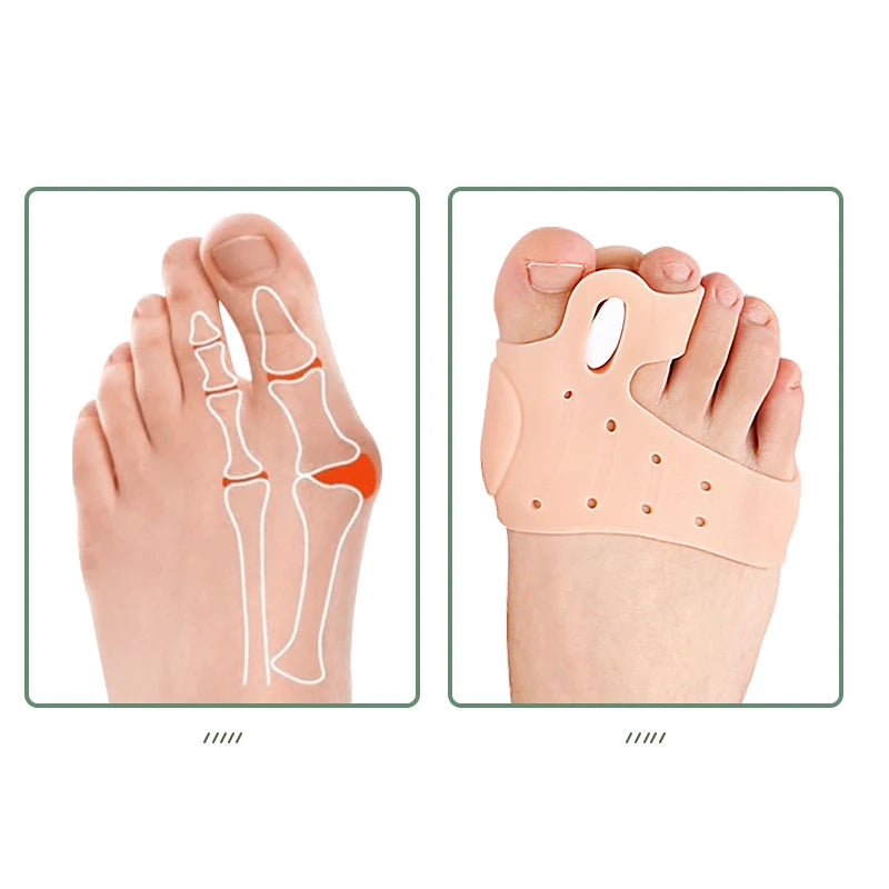 Adjustable Silicone Toe Spacers with Inserts for Overlapping Toes - image 3